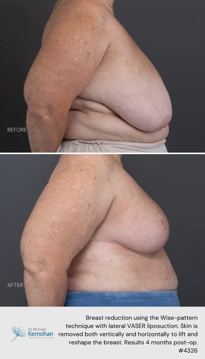 Breast Reduction Before and After Breast Reduction Before and After - 4326 Side