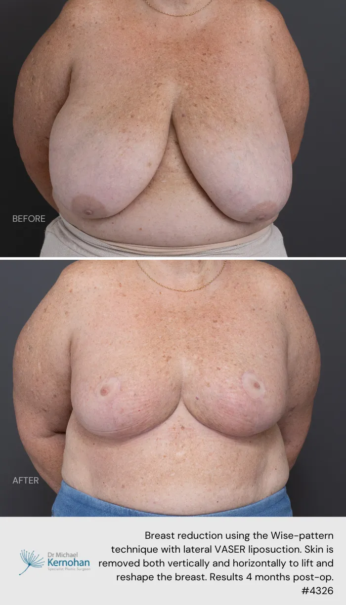 Breast Reduction Before and After Breast Reduction Before and After - 4326 Front