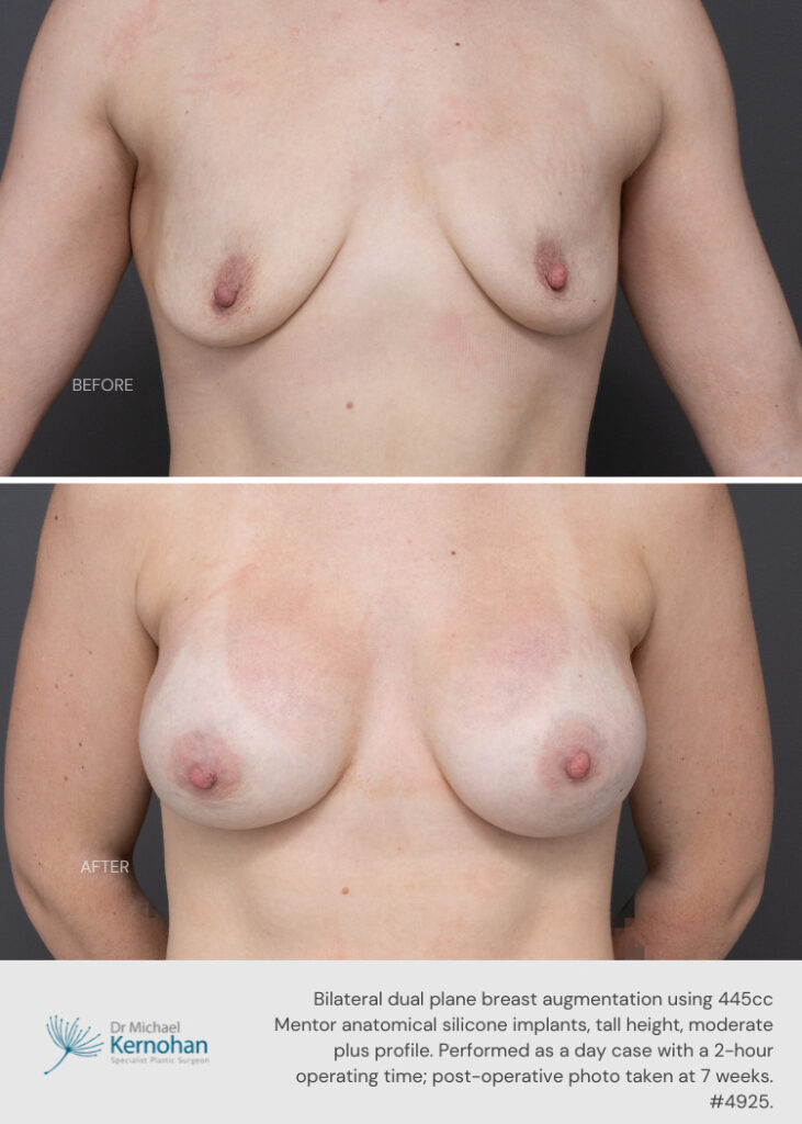Breast Implant Exchange Gallery - Dr Kernohan Patient 4925 Front