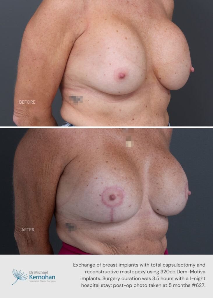 Breast Implant Exchange Gallery - 627-side 45