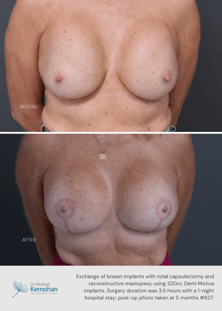Breast Implant Exchange Gallery - 627 Front