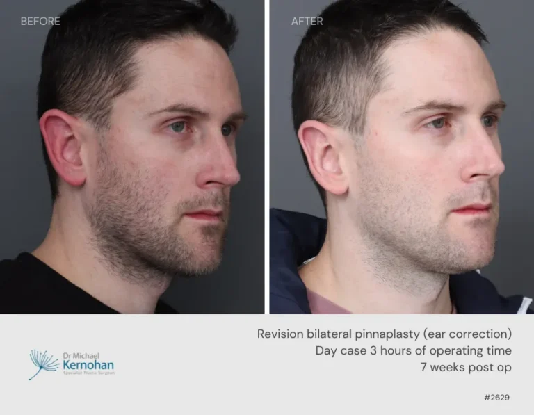 Pinnaplasty Before and After Pinnaplasty Before and After - 2629 45
