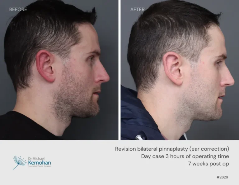 Pinnaplasty Before and After Pinnaplasty Before and After - 2629 Side