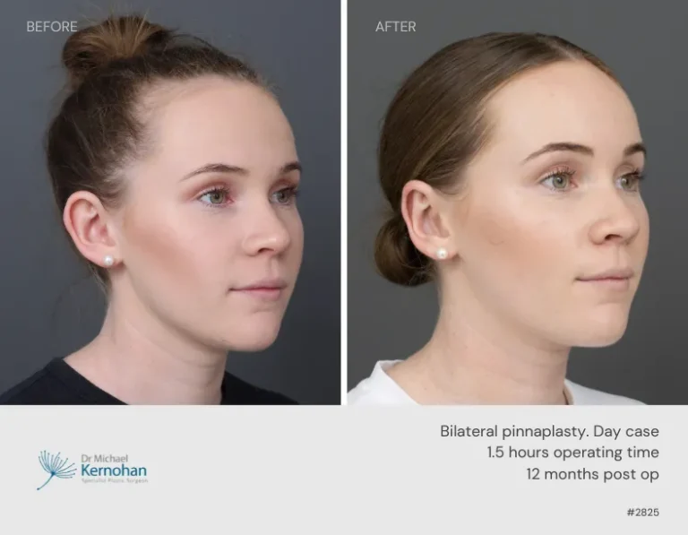 Pinnaplasty Before and After Pinnaplasty Before and After - 2825 45
