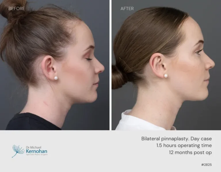 Pinnaplasty Before and After Pinnaplasty Before and After - 2825 Side