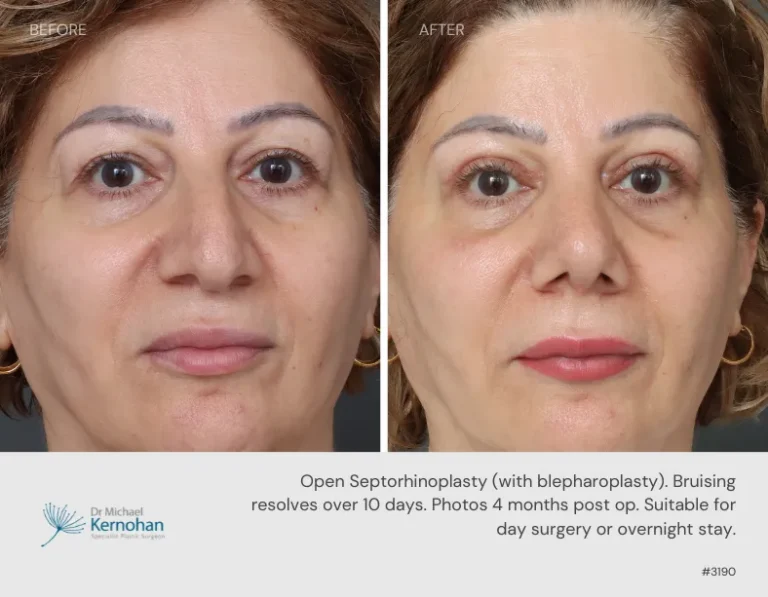 Rhinoplasty Before and After Rhinoplasty Before and After - 3190 Front