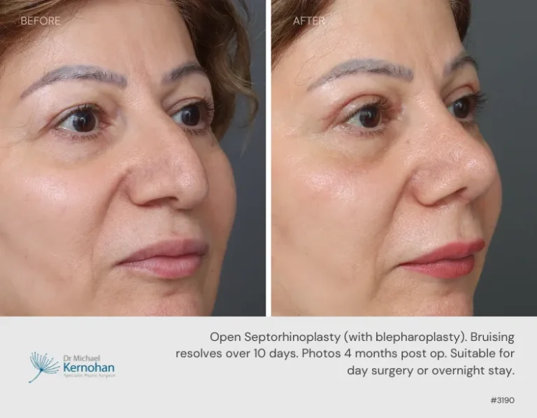 Rhinoplasty Before and After Rhinoplasty Before and After - 3190 45