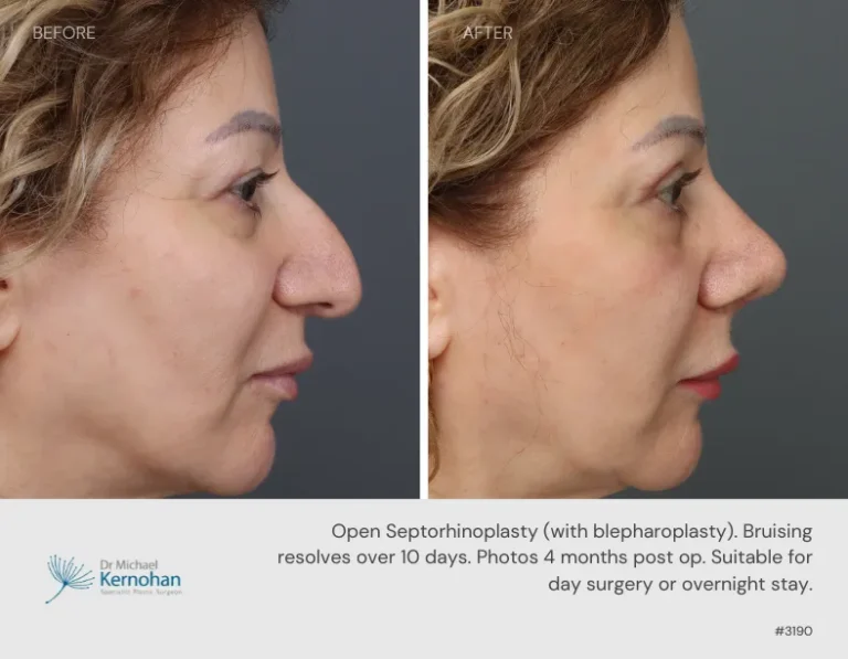Rhinoplasty Before and After Rhinoplasty Before and After - 3190 Side