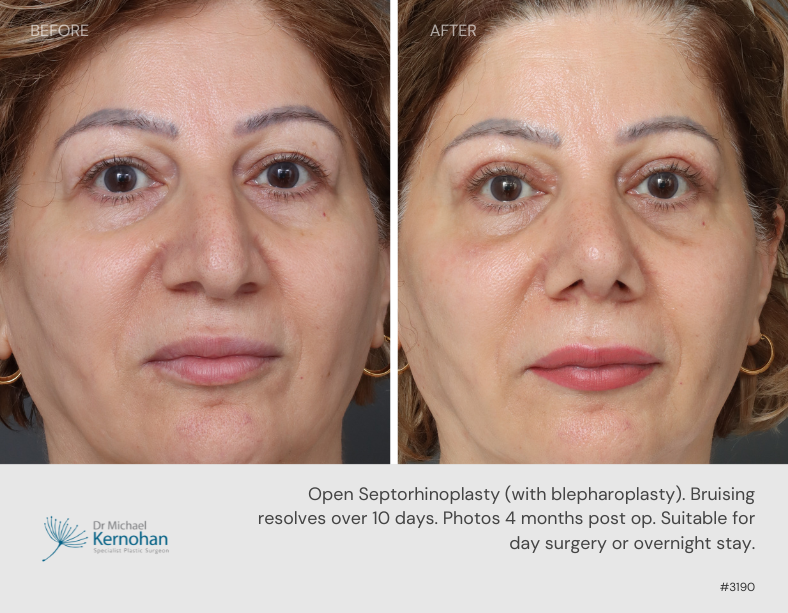 Rhinoplasty Before and After - 3190 Front