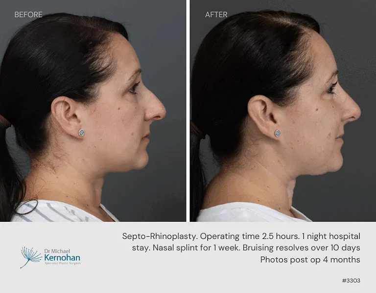 Rhinoplasty Before and After Rhinoplasty Before and After - 3303 Side