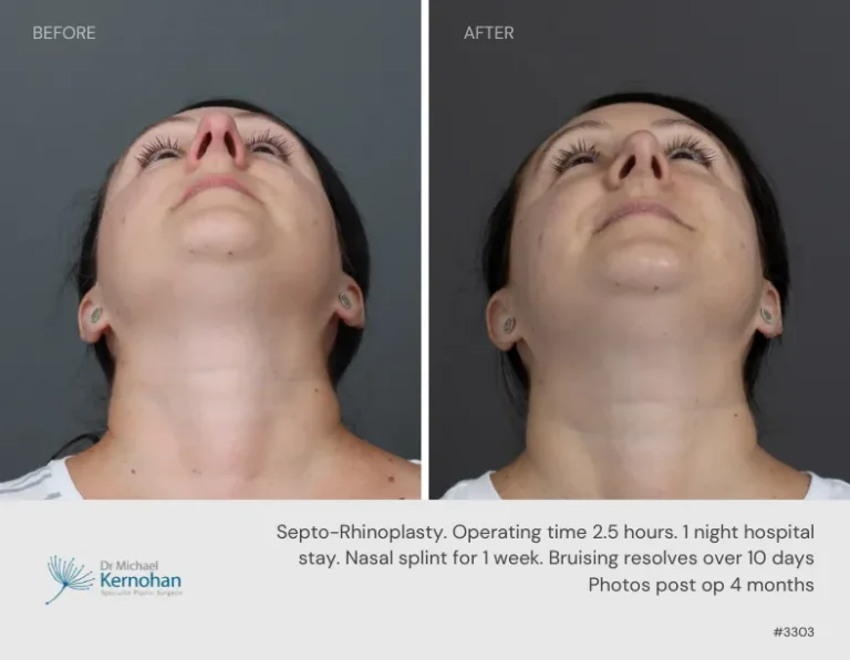 Rhinoplasty Before and After Rhinoplasty Before and After - 3303 Basal