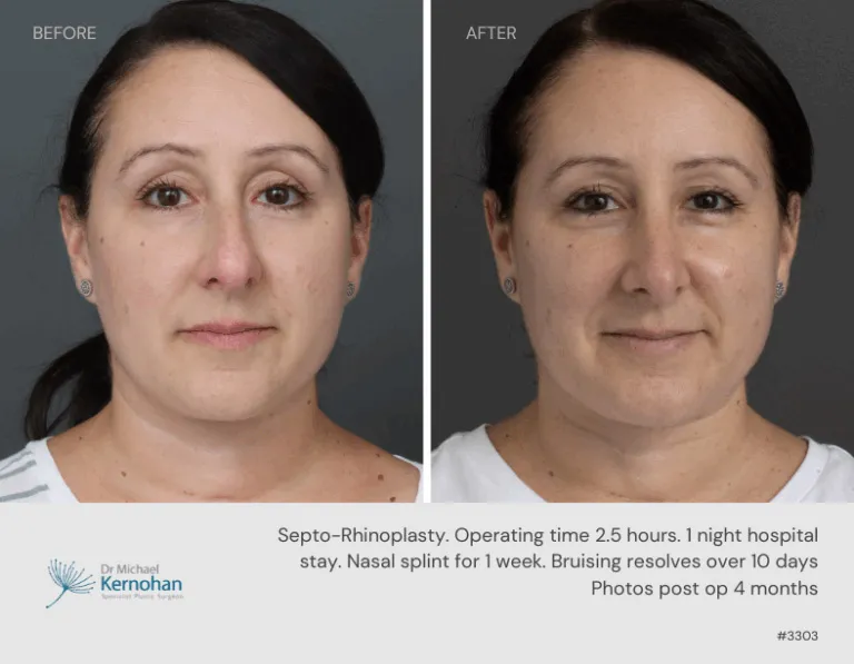 Rhinoplasty Before and After Rhinoplasty Before and After - 3303 Front