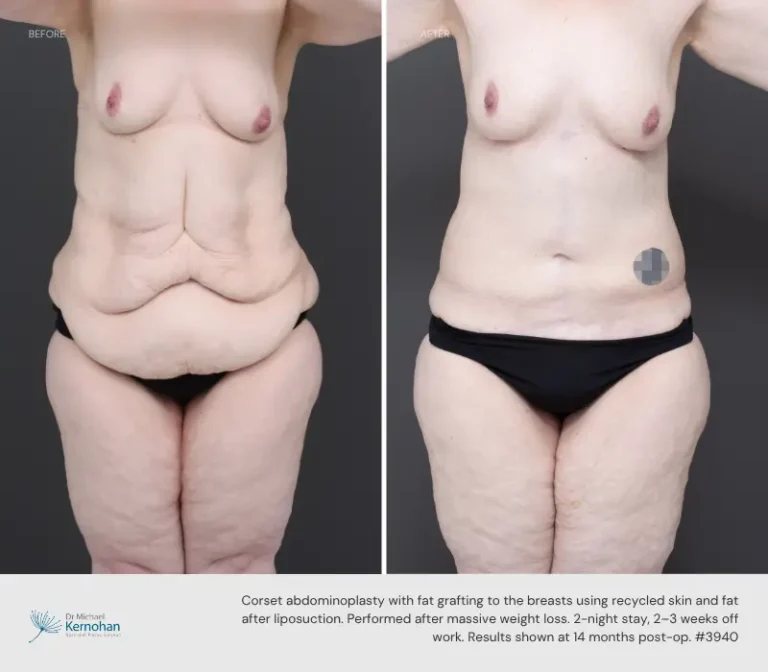 3940 Abdominoplasty Compression Garments for Fleur De Lis Surgery Blog - Corset Abdominoplasty Before and After Photos - 3940 Abdominoplasty