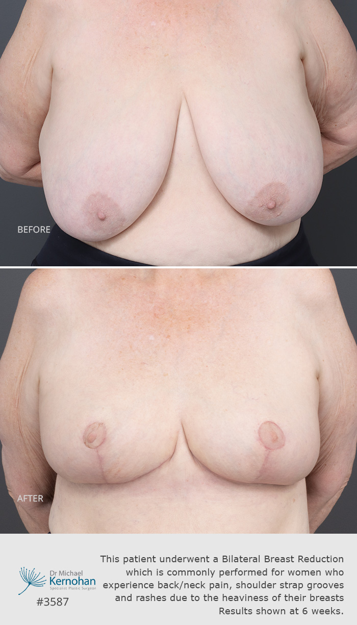 Abdominoplasty