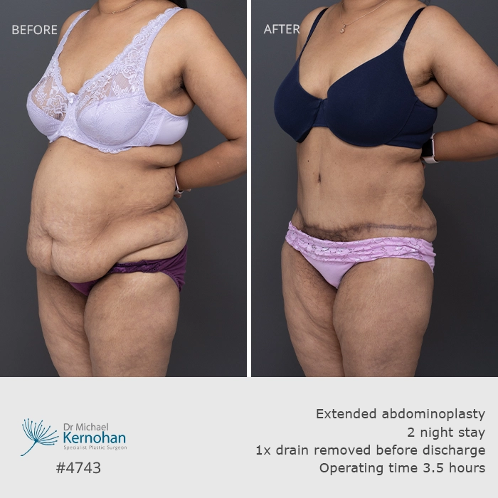 Past Patient Abdominoplasty Patient 14 Before and After Gallery