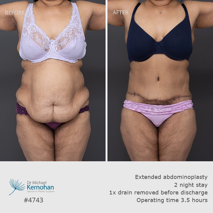 Past Patient Abdominoplasty Patient 14 Before and After Gallery