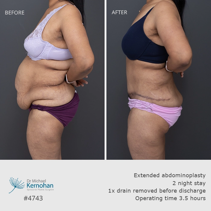 4743 Side Past Patient Abdominoplasty Patient 14 Before and After Gallery