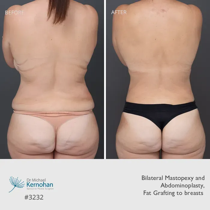 Breast and Body Combination Before and After Breast and Body Combination Before and After Patient 3232 Back