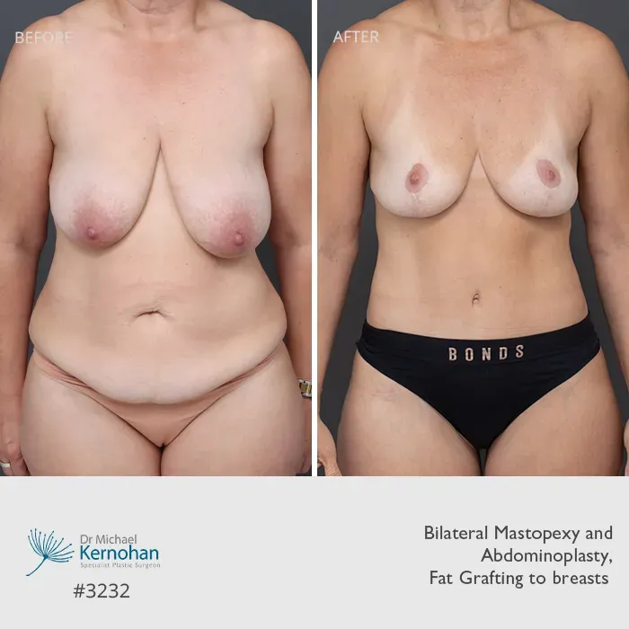 Breast and Body Combination Before and After Breast and Body Combination Before and After Patient 3232Front
