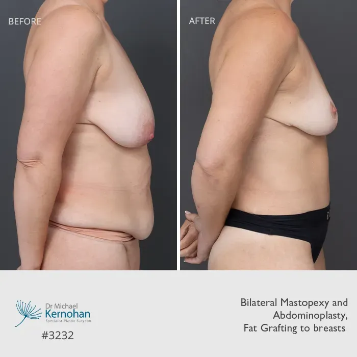 Breast and Body Combination Before and After Breast and Body Combination Before and After Patient 3232 Side