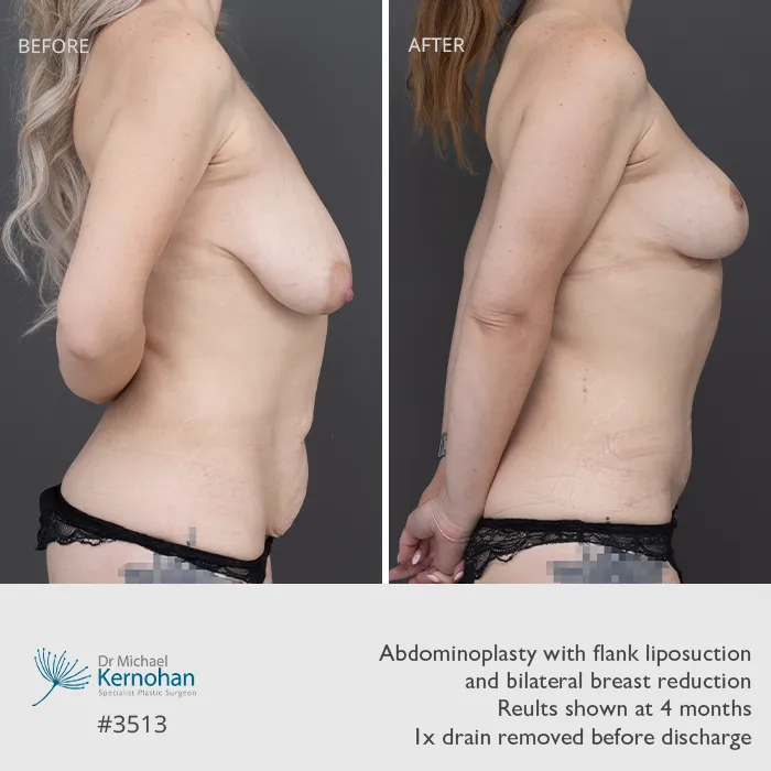 Breast and Body Combination Before and After Breast and Body Combination Before and After Patient 3513 Side