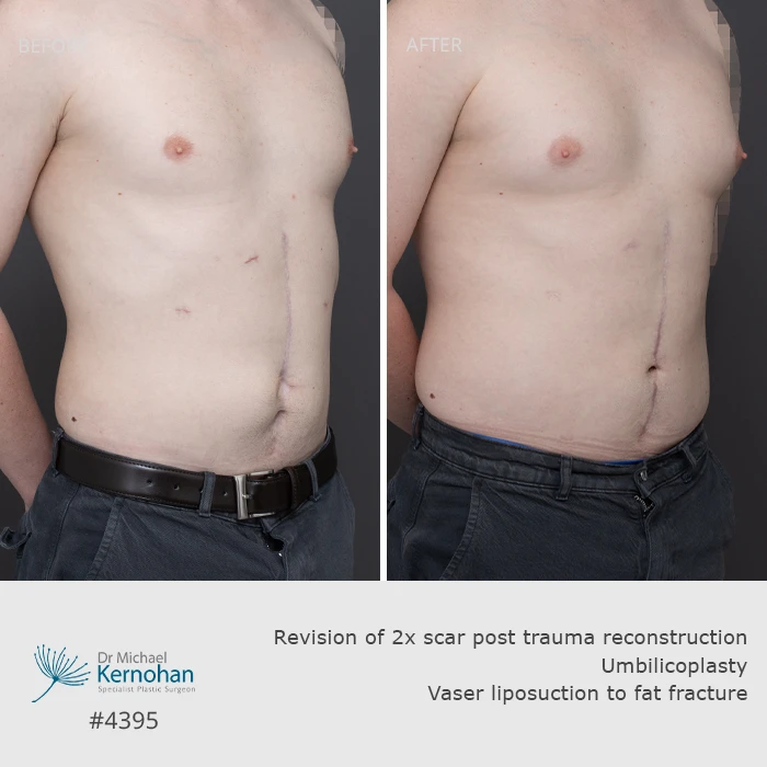 Scar Revision Before and After Scar Revision Before and After Patient 4395 - 45