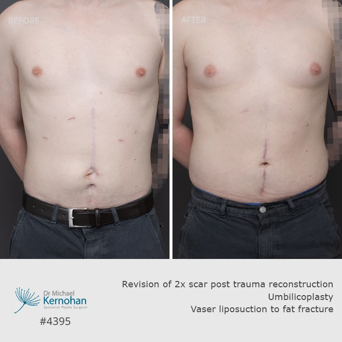 Scar Revision Before and After Scar Revision Before and After Patient 4395 - Front