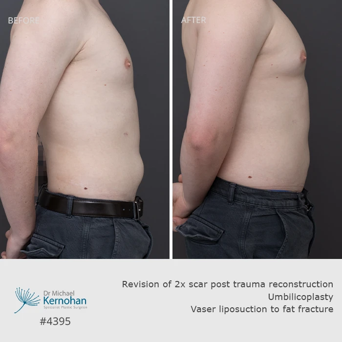 Scar Revision Before and After Scar Revision Before and After Patient 4395 - Side